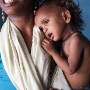 Jyoti is so malnurished she is losing her hair and has skin conditions.